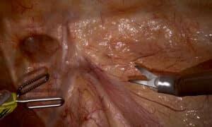 Hernia Incision and Dissection