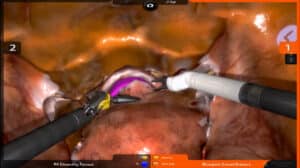 Robotix Hyst Colpotomy
