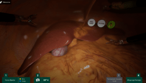 cholecystectomy Scene