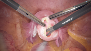 Cystectomy Ovarian Cyst