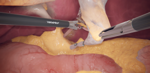 CysticPedicleDissection-VarIII-SI