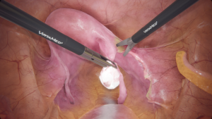 Treatment of Adnexa With Adnexectomy