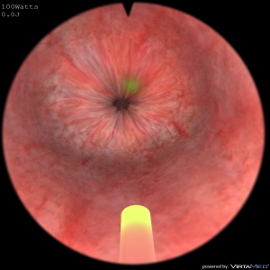 UroSim_LaserBPH_55grams_CameraView3